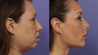 Chin Augmentation at Stoker Plastic Surgery [upl. by Legra]