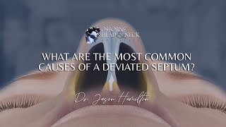 What are the most common causes of a deviated septum [upl. by Lehcir617]