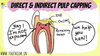 DIRECT AND INDIRECT PULP CAPPING  Vital pulp therapy  Pediatric Dentistry [upl. by Abrahamsen819]