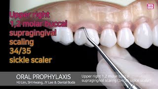 Upper right 12 molar buccalsupragingival scaling 3435 sickle scaler [upl. by Culhert]