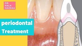 Periodontal Treatment [upl. by Svirad]