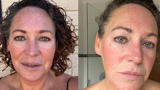 Biorepeel Chemical Peel with Microneedling Before and After [upl. by Liu]