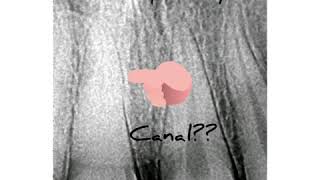 Root canal treatment in Calcified Canal [upl. by Miharba]