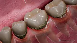 Exploring Flap Surgery Scaling and Root Planing for Optimal Oral Health [upl. by Mcwherter457]