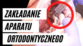 Zakładanie aparatu ortodontycznego  krok po kroku  VLOG3 [upl. by Aldwin454]