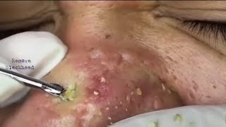 Acne Treatment Blackhead Removal on his nose Remove Blackhead removeblackhead [upl. by Darsie]