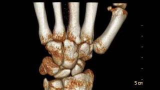 CTTC Multislice  Wrist Fracture  Fratura Punho  scaphoid [upl. by Opportuna191]