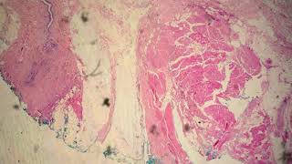 Acinic Cell Carcinoma [upl. by Ailehs]