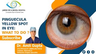 Pinguecula Yellow Spot in Eye What to do [upl. by Siana]