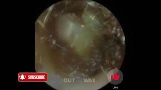 Soft Waxy Earwax Removal  Outwiththewax [upl. by Michaele]