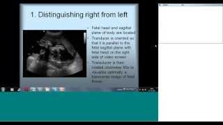 Fetal Echocardiography Basic Views by Dr Sejal Shah [upl. by Htnnek]