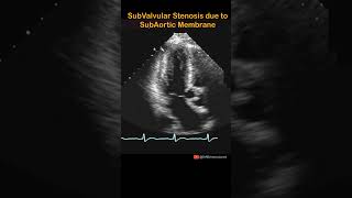 Subvalvular Aortic Stenosis cardiology echocardiography shorts echocardiogram aorticstenosis [upl. by Gaylord]