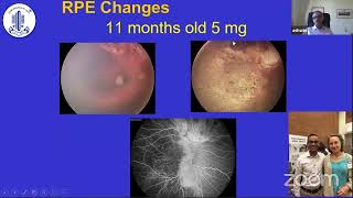 Intraarterial Chemotherapy for Retinoblastoma Current StatusDr Ashwin Reddy [upl. by Eyde424]