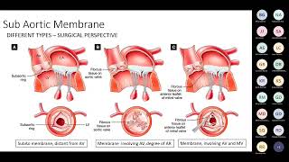 Subaortic membrane Mr Attilio Lotto [upl. by Enasus372]