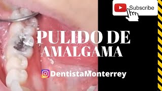 AMALGAMA Dental 👅 PULIDO [upl. by Calderon807]