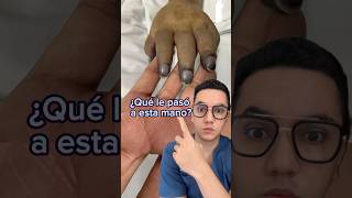 ¿Qué le pasó a esta mano Acrocianosis Dr William Guerrero medicina shorts [upl. by Adehsor]