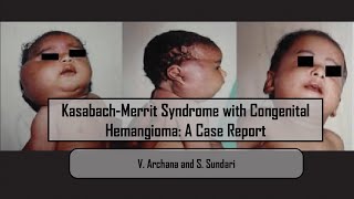 KasabachMerrit Syndrome with Congenital Hemangioma A Case Report [upl. by Suivart]