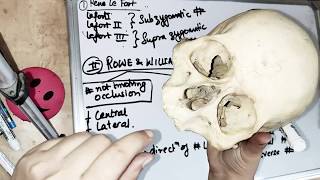 midfacial fractures  intro and classification [upl. by Anayra207]