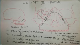 LE FORTII FRACTURE LINE [upl. by Adnorehs]