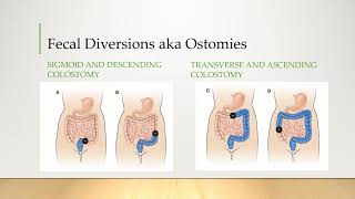 Ostomy VIDEO [upl. by Manolo]