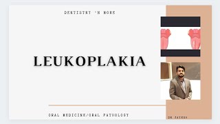 LEUKOPLAKIA [upl. by Derwin]