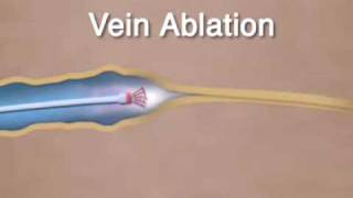 Varicose Vein Ablation amp Closure [upl. by Elyad]