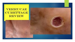 Video  verrucae curettage review [upl. by Trah]