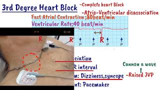 AV Heart Block  First degree heart Block  Mobitz type1  Mobitz type2  Complete heart Block [upl. by Yamauchi]