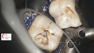 Post Endodontic Restoration Mandibular Molar SDR Plus Spectrum OptraSculpt [upl. by Nivlem250]