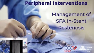 Management of SFA InStent Restenosis [upl. by Ahsets]