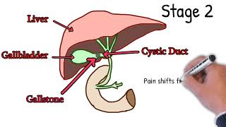 Cholecystitis  Symptoms Causes Treatment How to Detect Cholecystitis Merphy sign Explained Easy [upl. by Dloreg]