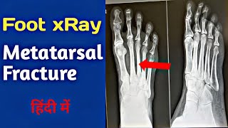 How to read Fracture of XRay FootMetatarsal Fractureपैर का फैक्चर एक्सरे कैसे देखेंUdayXray [upl. by Ahsas]