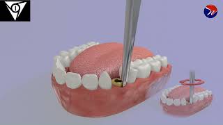 M1 Atraumatic ankylosed root extraction using pre elevator 1 [upl. by Aleunam805]