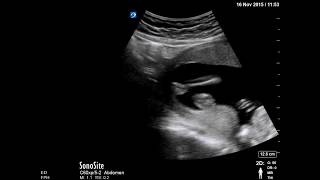 Ultrasound for Trauma in Pregnancy [upl. by Yentyrb549]