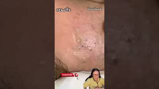 blackheads nose blackheads removal satisfying blackheads removal lips [upl. by Rahab815]