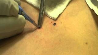 Microdermal Dermal Anchor Removal at MediZen Cosmetic Clinic Birmingham UK [upl. by Archangel]