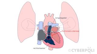 Pulmonalisstenose [upl. by Anelaj]