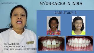 Myobrace case presentation 2 [upl. by Panther]