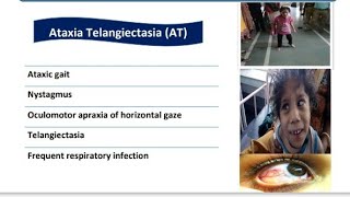 Ataxia Telangiectasia  Spot Diagnosis  12  Pediatrics [upl. by Granthem]