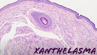 Xanthelasma xanthoma of eyelid yellow bumps around eye pathology dermpath dermatology [upl. by Miru]