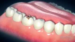 Dental Crowns Everything You Need to Know [upl. by Slavin56]