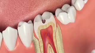 Avoid Rootcanal therapy with Indirect Pulp capping [upl. by Einegue653]