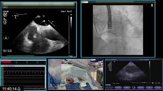 Watchman implant procedure [upl. by Randy]