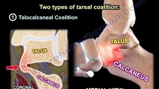 Tarsal Coalition  Everything You Need To Know  Dr Nabil Ebraheim [upl. by Namurt]