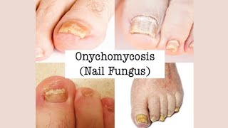 ONYCHOMYCOSIS symptoms treatment and prevention [upl. by Scarlett548]