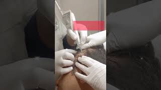 Seborrheic keratosis treatment  Laser Treat [upl. by Eibo]