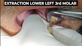 EXTRACTION LOWER THIRD MOLAR  THIRD MOLAR EXTRACTION  MOLAR EXTRACTION  LOWER MOLAR EXTRACTION [upl. by Pryce]