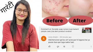 femcinolA gel को पूरे face मे लगा सकते है या सिर्फ़ acne मे Kiransrana [upl. by Maddie]