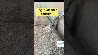 Huge Ingrown hair removal😲 [upl. by Annaear]