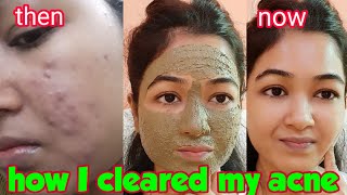 AntiAcne Face Mask How I Cured My Hormonal Cystic Acne  Neem Tulsi Face pack for Acne Pimples [upl. by Lleira]